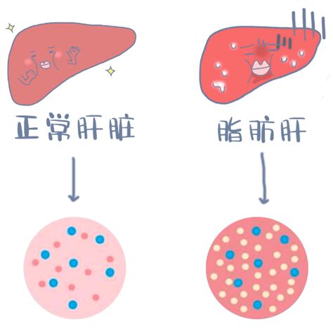 得了脂肪肝不要怕！学会这几招，把脂肪“甩”出肝脏！疾病症状患者