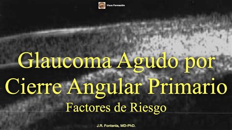 Glaucoma Agudo Por Cierre Angular Primario Factores De Riesgo Youtube