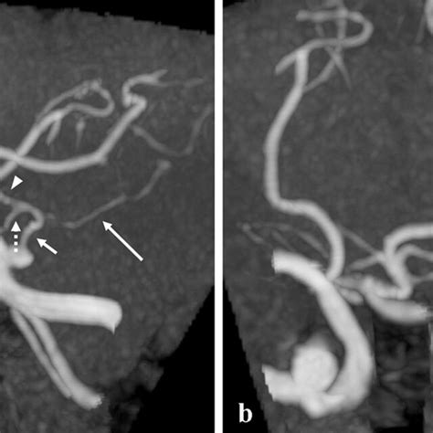Anteroposterior A And Left Anterior Oblique B Projections Of