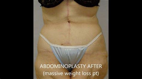 Fleur De Lis Abdominoplasty Youtube