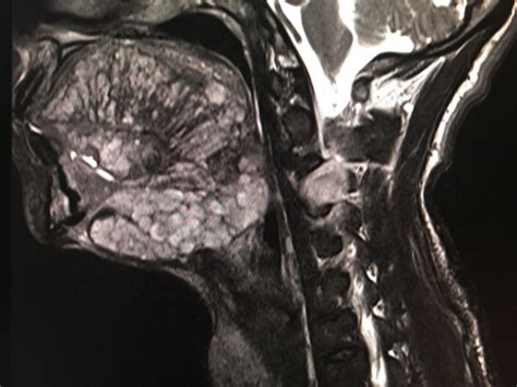 Plexiform Neurofibroma In Oral Cavity With Cervical Neurofibroma