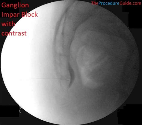 Cervical Spine Fluoroscopic Anatomy for the Pain Management ...