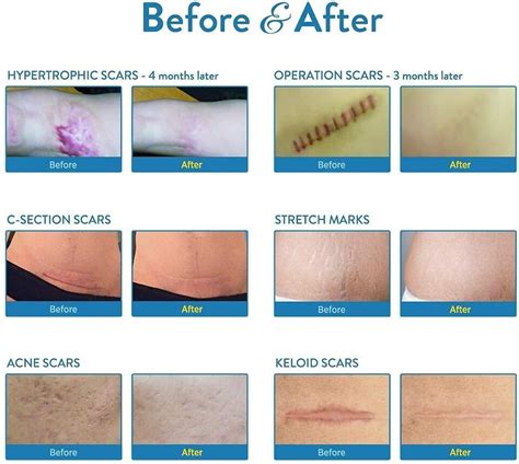 Aroamas Medical Grade Silicone Scar Removal Sheets And Gel Exp Ebay