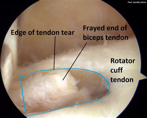 Rotator Cuff Tear Arthroscopic Surgery