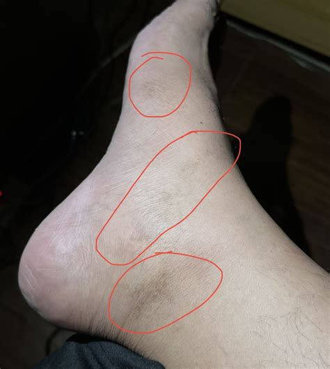 [skin Concern] I Have These Dark Spots All Over My Feet I Can’t Get Rid Of Them What Do You