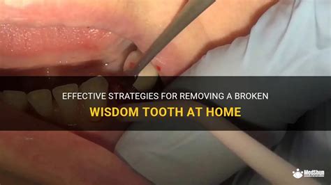 Effective Strategies For Removing A Broken Wisdom Tooth At Home Medshun