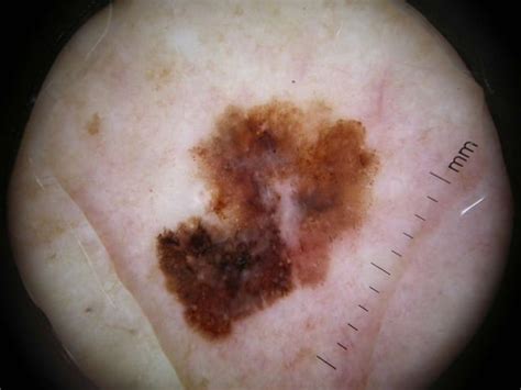 Superficial Spreading Melanoma In Situ Developed On A Melanocytic Nevus