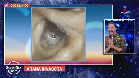 Video Araña Invasora En Un Oído Ojo Clínico Sale El Sol Youtube