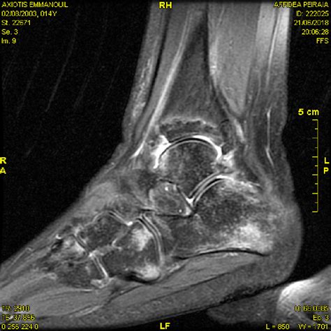 Cuboid Fracture Treatment Robofasr