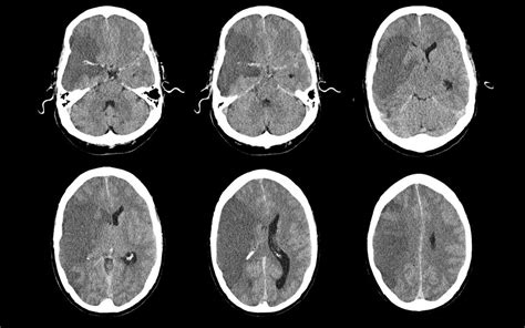 Right Mca Territory Brain Infarct Ct 11 Lghmgr3radi Flickr