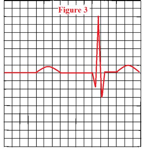 How to Measure the PR Interval on an EKG Strip | PR Interval EKG Quiz