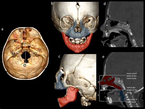 Quantitative Analysis Of The Craniofacial Complex And Airway 3d Ct