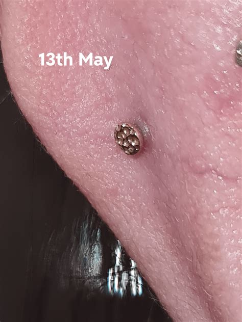 Irritation Bump Getting Worse R Piercing