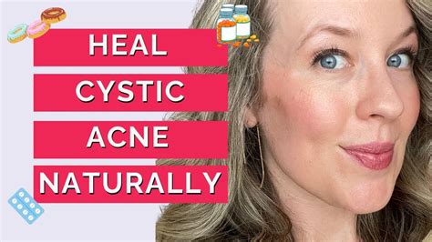 Cure Cystic Acne Naturally In 8 Weeks With 6 Action Steps Youtube