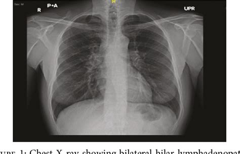 Figure From Diagnosis Of Hodgkin S Lymphoma Using Endobronchial