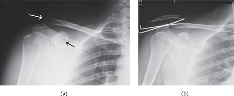 Figure 2 From Acromioclavicular Dislocation Associated With Coracoid Process Fracture Report Of