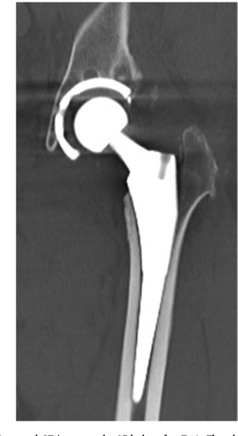 Figure 2 From Bone Ingrowth Observed In A Cup Removed During Revision