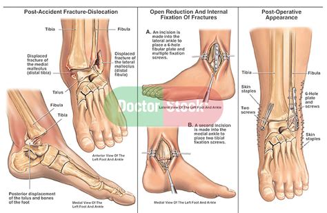 Bimalleolar Left Ankle Fracture Dislocation With Surgical Fixation