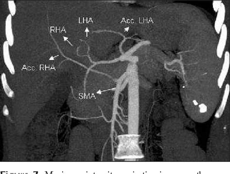 Celiac Artery Cat