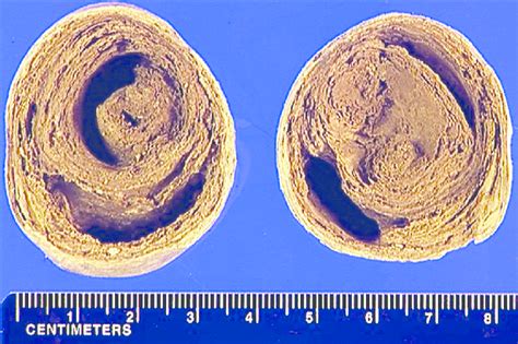 Axial Section Through The Left Renal Stone Demonstrating Multiple