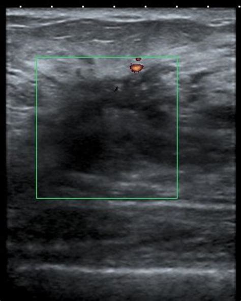 Sclerosing Adenosis Of The Breast Pacs