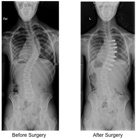 Minimally Invasive Fusionless Surgery For Ais Samuel K Cho Md