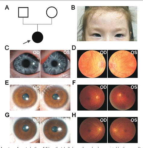 Figure 1 From Dystrophia Canthorum In Waardenburg Syndrome With A Novel Mitf Mutation