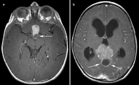 Suprasellar And Pineal Gland Trilateral Retinoblastoma Download Scientific Diagram