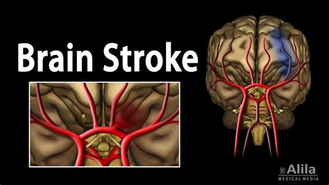 Brain Stroke, Types of, Causes, Pathology, Symptoms, Treatment and ...