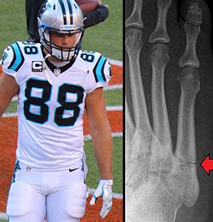 Understanding Greg Olsen's Foot Injury - The Infamous Jones Fracture