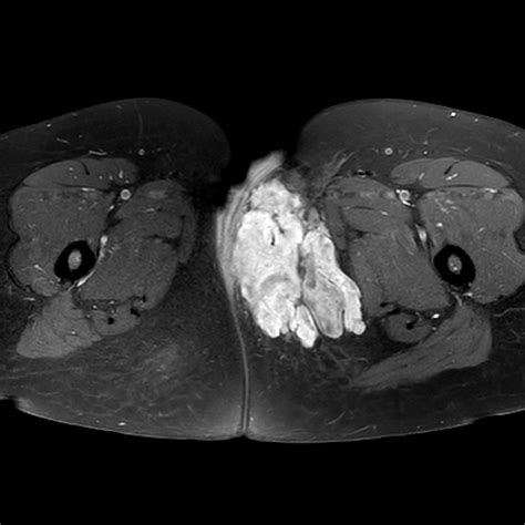 Liposarcoma Radiology Reference Article