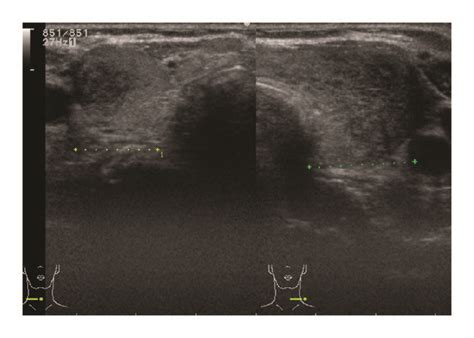 Ultrasonography Of The Thyroid A Heterogeneous And Hypoechoic Areas