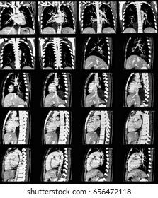 Computed Tomography Ct Scan Chest Abdomen Stock Photo