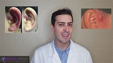 Sinus Pre Auricular Coloboma Auris Youtube