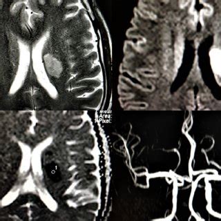 Magnetic Resonance Imaging MRI Images A Fluid Attenuation