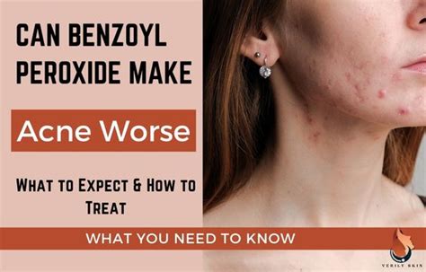 Benzoyl Peroxide Side Effects