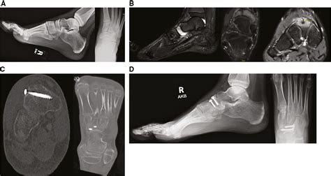 View Of Navicular Stress Fractures In Adolescent Athletes Injury