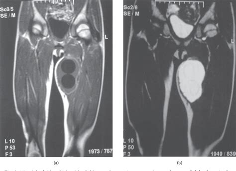 Figure 1 From Primary Hydatid Cyst Of The Thigh A Case Report Of An Unusual Localization