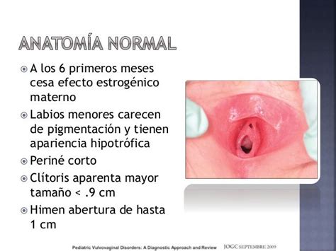 Candidiasis Vulvovaginitis Pediátrica Y Cervicitis