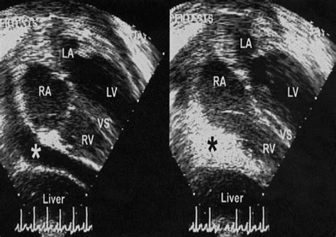 Echocardiography Guided Interventions Journal Of The American Society