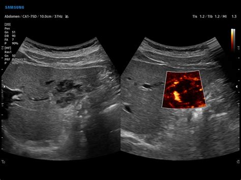 Ultrasound images - Liver hemangioma, MV-Flow, echogramm №916