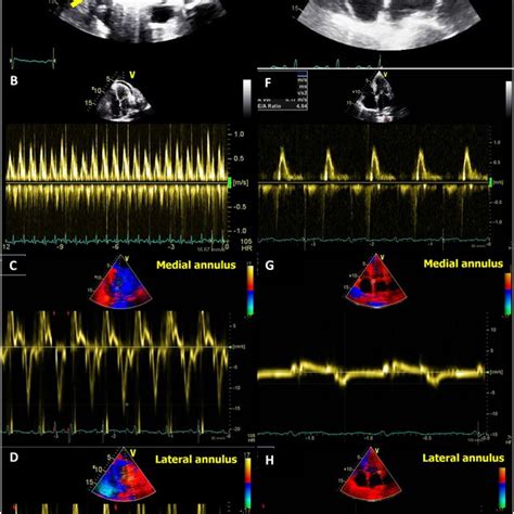 Salient Echocardiographic Differences Between Constrictive Pericarditis Download Scientific