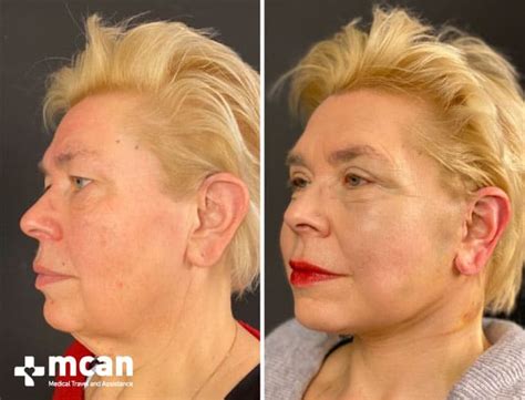 Lifting Facial Ritidectom A En Turqu A Mcan Health