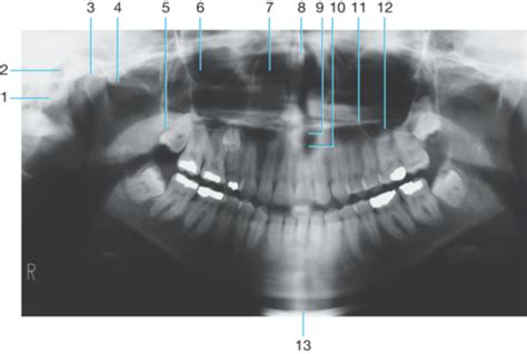 Chapter 22 Recognizing Normal Radiographic Anatomy Panoramic