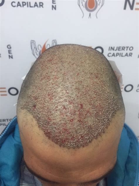 Ufs Dra Moreno Neo Injerto Capilar Foro Sobre Alopecia