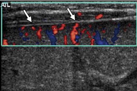 Biliary Atresia Color Doppler Us Findings In Neonates And Infants