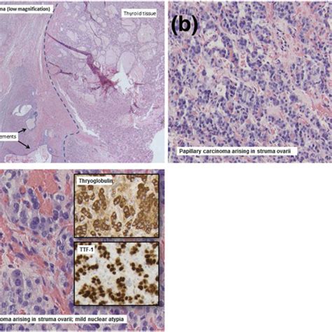 A Diagnostic I 123 Whole Body Scan Pretreatment Scan Showing Uptake