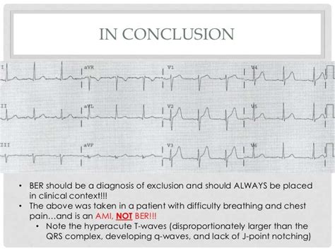 Benign Early Repolarization