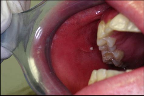 Rapidly Progressing Bilateral Submandibular Sialadenitis And