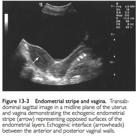 Uterine Ultrasound Imaging